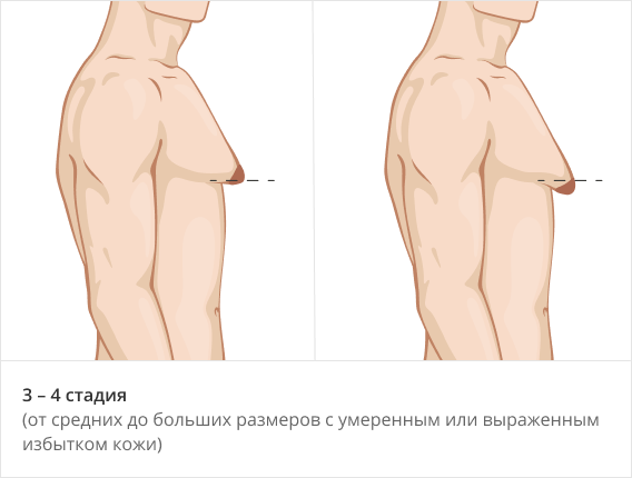 3-4 стадия